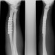 Fracture of the shaft of radius, secondary healing, malunion: X-ray - Plain radiograph